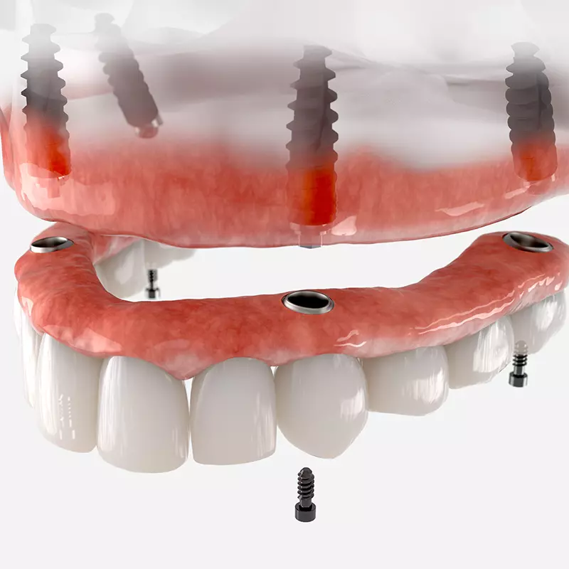 All on Four Implants Illustration