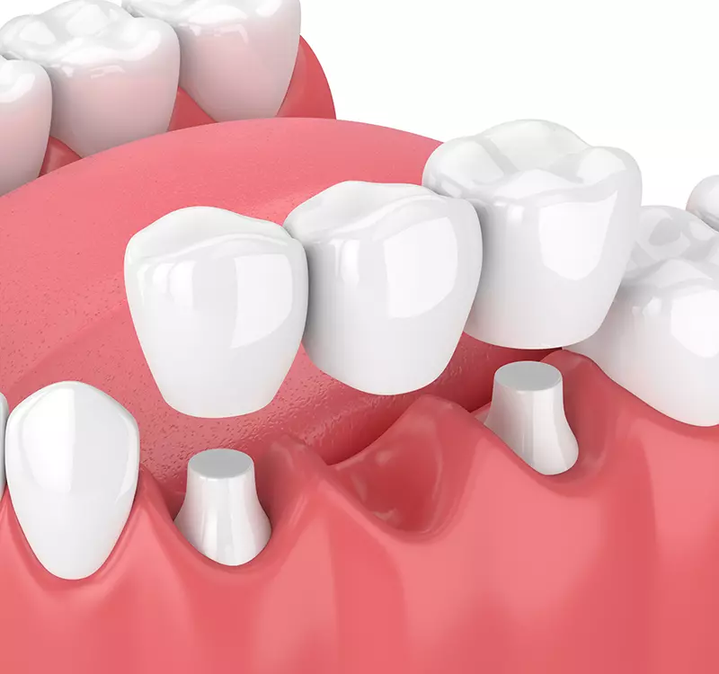 Dental Bridge Illustration