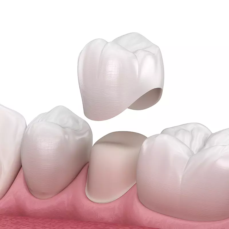 Dental Crown Placement Illustration