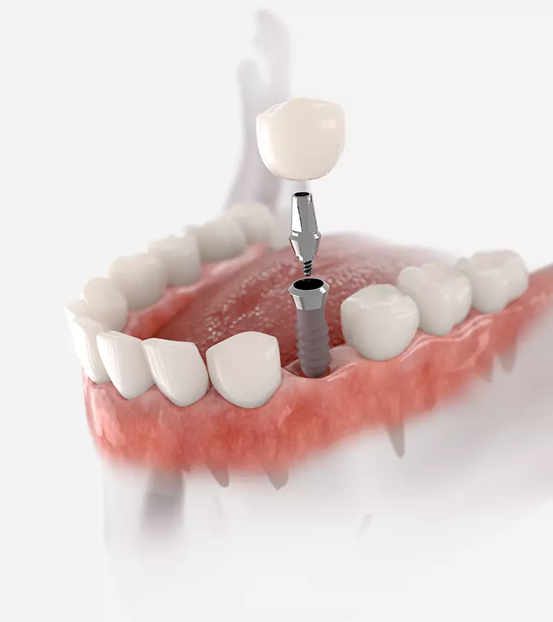 Single Lower Dental Implant Illustration