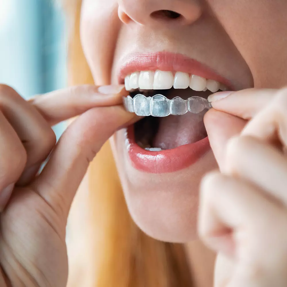Woman Using Invisalign Trays